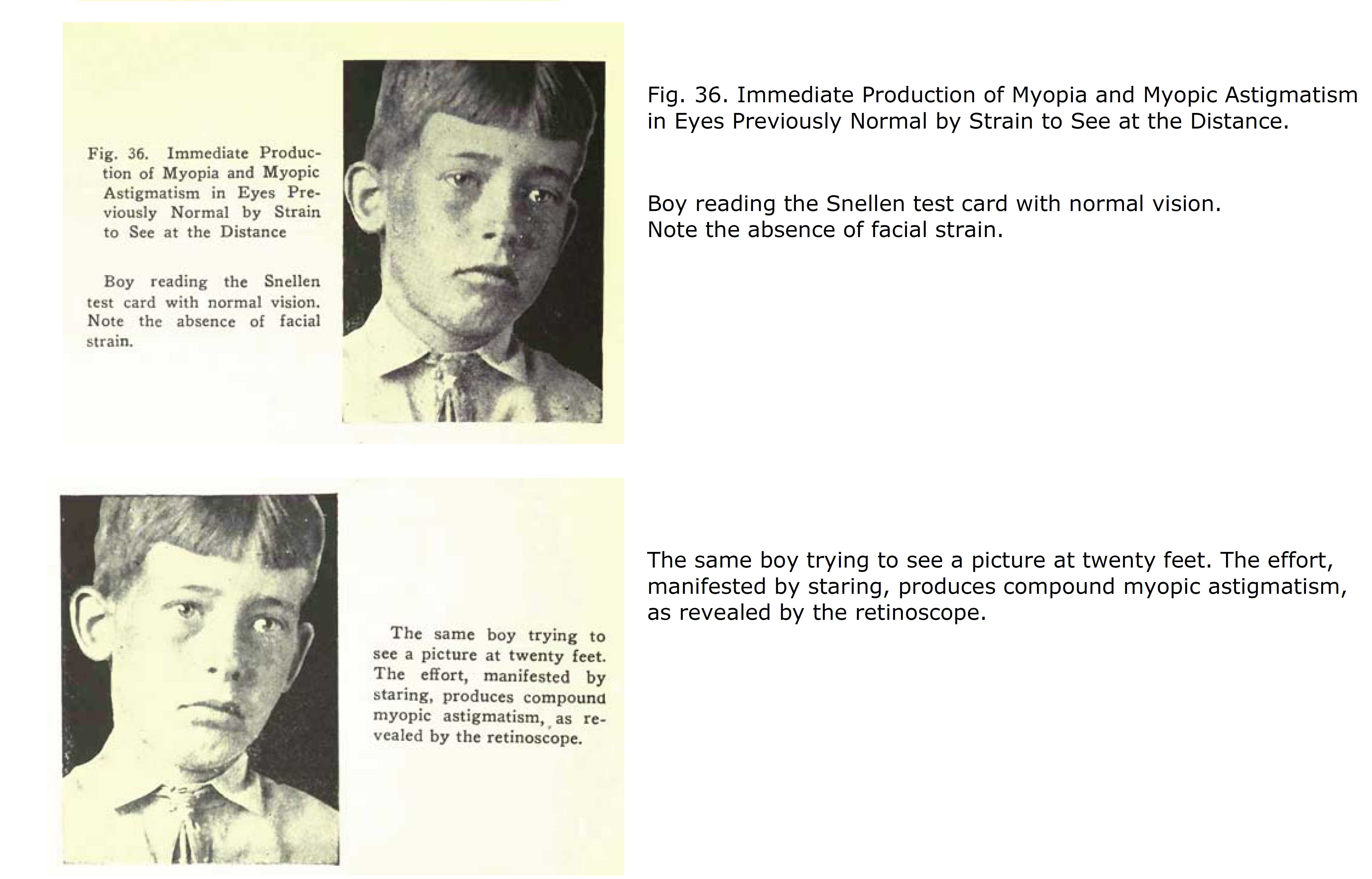 Staring, Squinting, Effort causes unclear eyesight