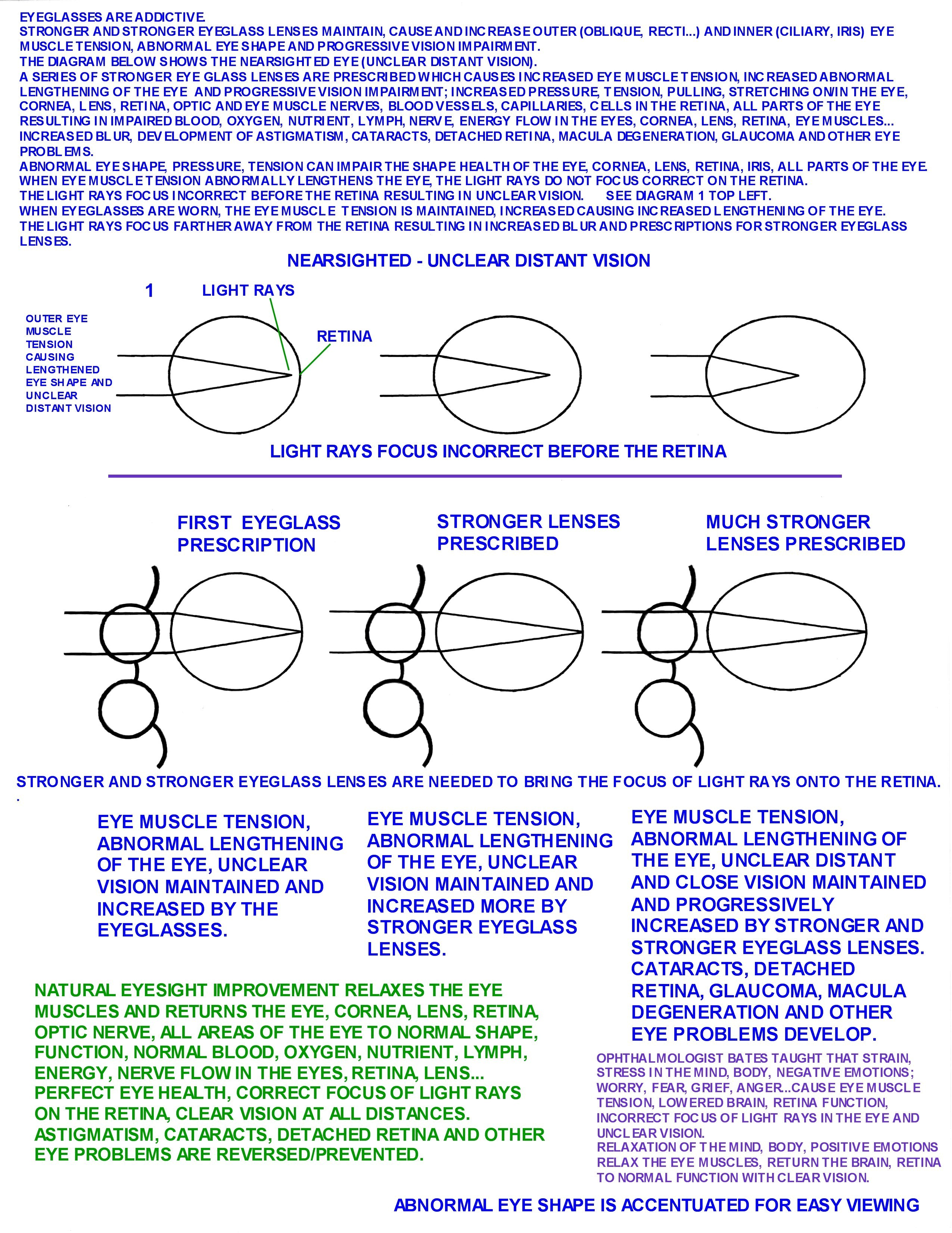 LENGTHENED_EYE_CAUSES_UNCLEAR_DISTANT_VISION.jpg LENGTHENED_EYE_CAUSES_UNCLEAR_DISTANT_VISION.jpg