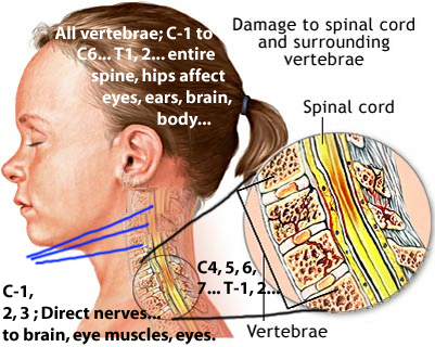 Neck Injury Caused by Dishonest Chiropractor