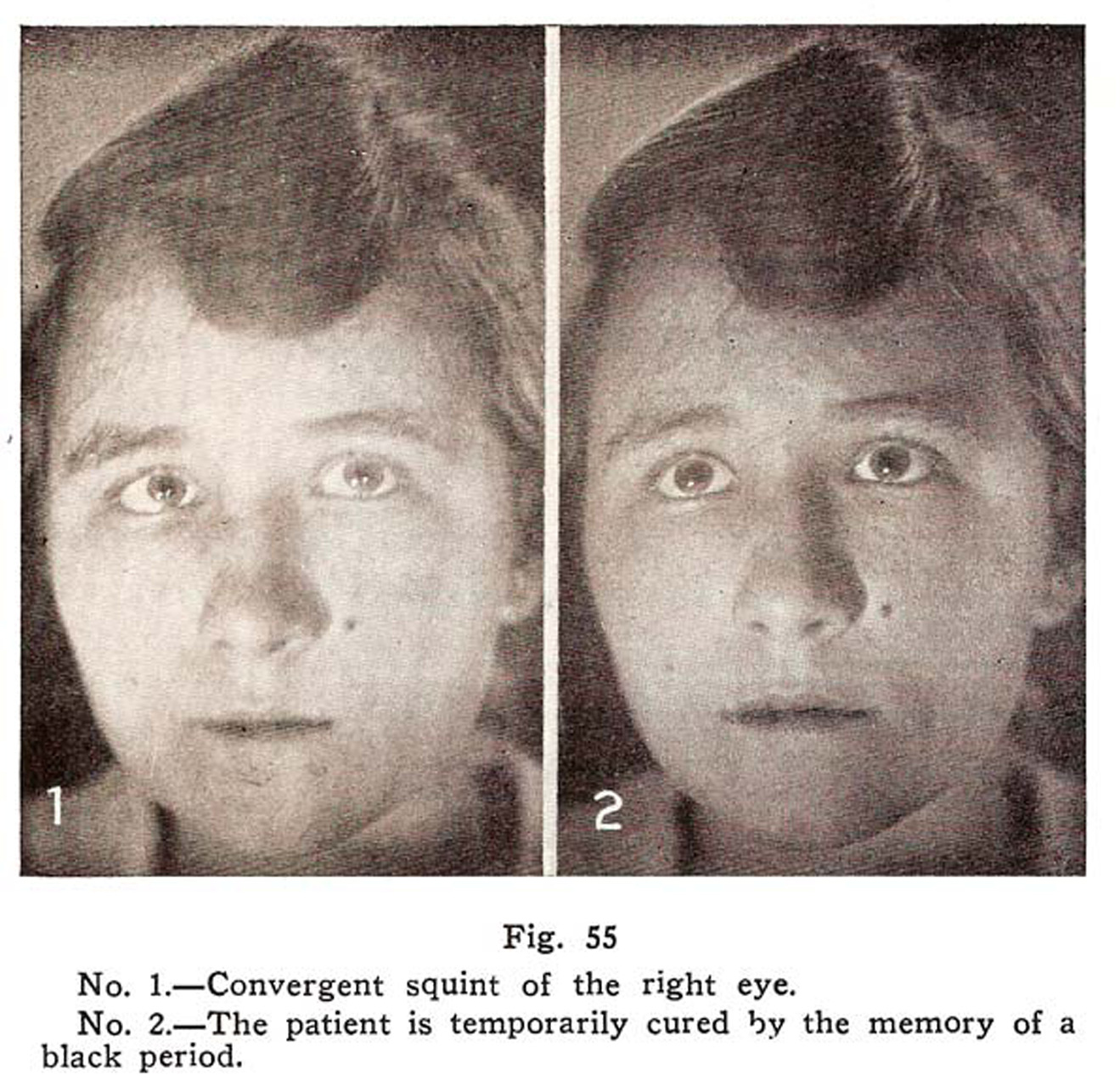 Cross Eye Corrected by Dr. Bates Natural Method Without Surgery, No Glasses