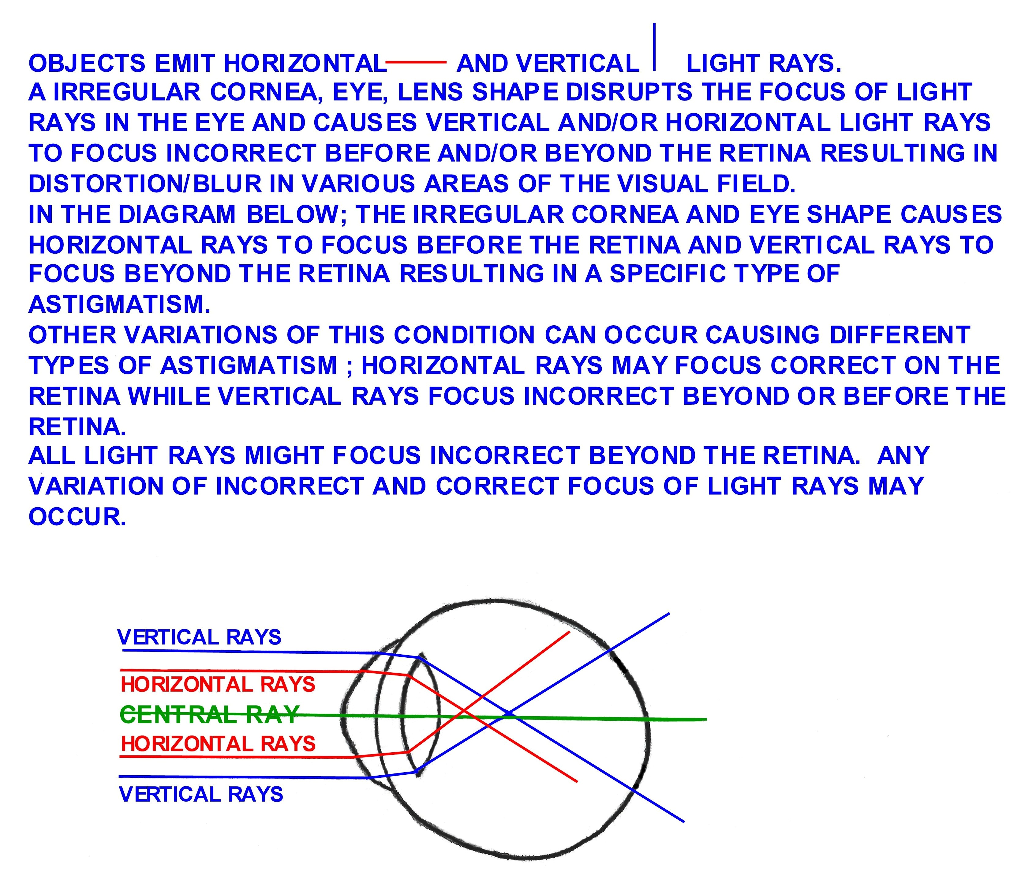 astigmatism_001.jpg