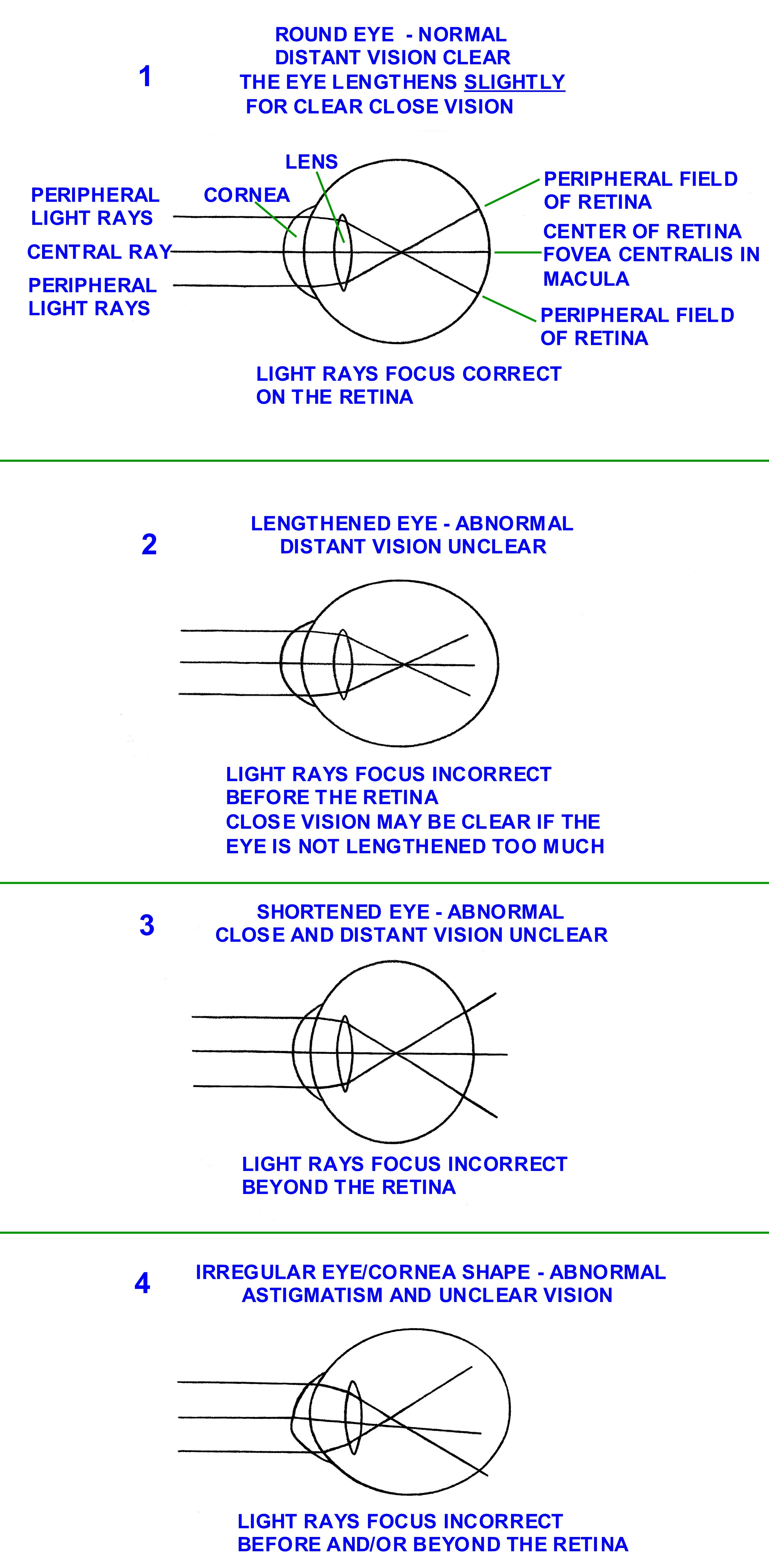 eye__muscle_tension_affects_shape_of_eye_001.jpg