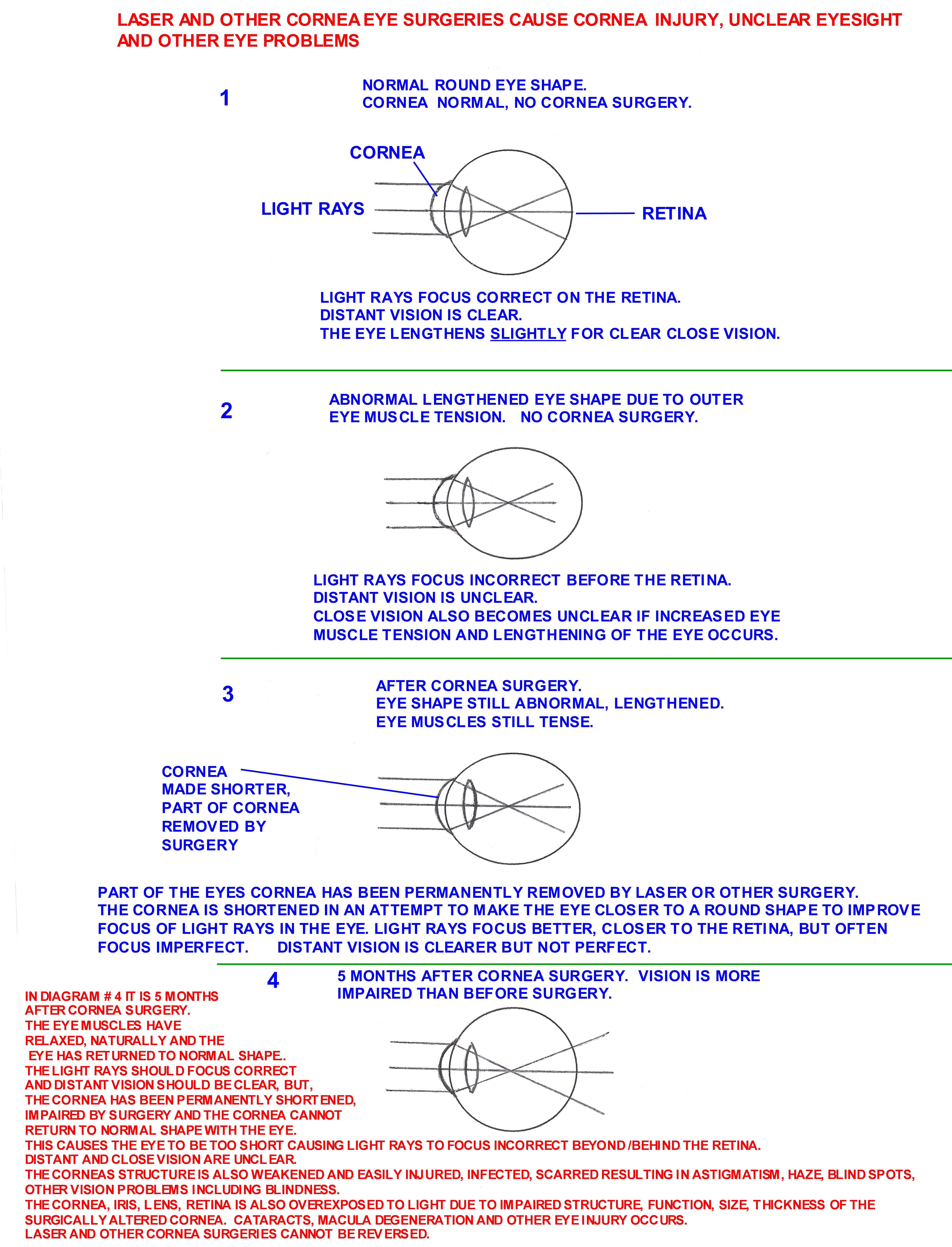 impaired_cornea_due_to_laser_surgery_001.jpg