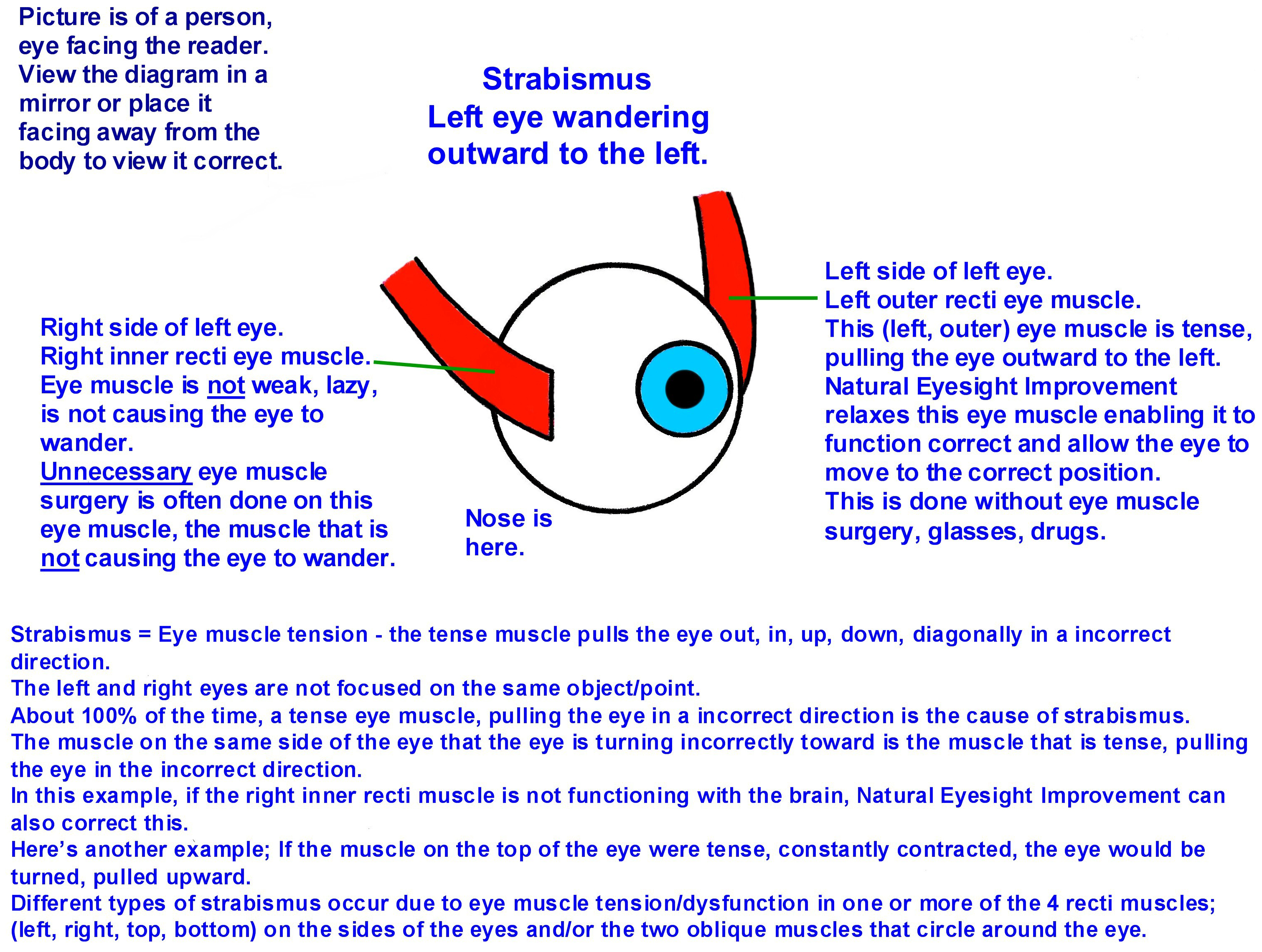 Eye wanders outward due to pull of tense outer side recti eye muscle. A tense inner side recti muscle will pull the eye inward; cross eye.